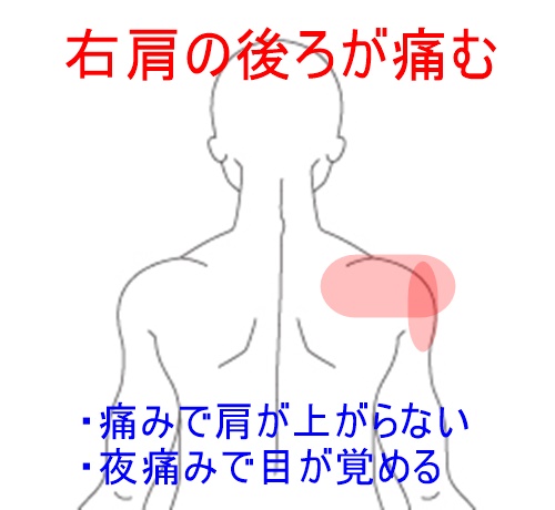 治療例2 じっとしていても肩が痛む 五十肩 治療室そら 藤沢市湘南台の鍼灸院 ハリ 鍼灸 逆子 肩こり 腰痛