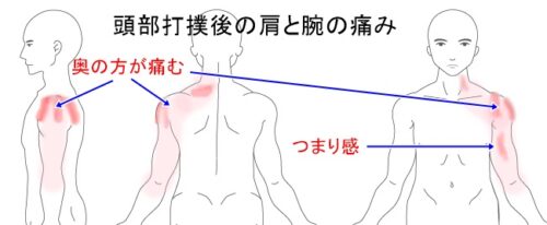 治療例3 頭を打った後の肩と腕の痛み 治療室そら 藤沢市湘南台の鍼灸院 ハリ 鍼灸 逆子 肩こり 腰痛