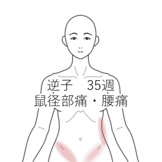 鼠径部痛 恥骨痛 治療室そら 藤沢市湘南台の鍼灸院 ハリ 鍼灸 逆子 肩こり 腰痛